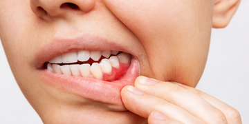 A close-up of a person pulling back their lower lip to reveal red, inflamed gums, possibly indicating gum disease or irritation. Their teeth appear clean and white.