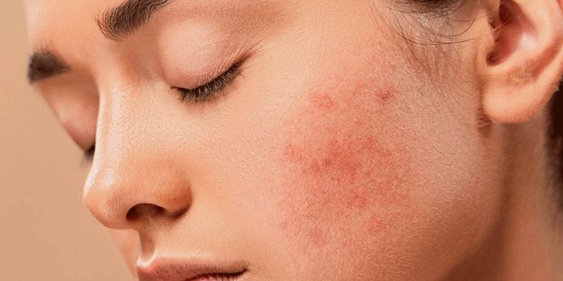 A close-up of a young woman's face with closed eyes, showing red, inflamed acne or rosacea on her cheek. Her skin has visible texture and redness against a neutral background.