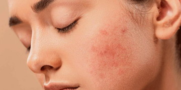 A close-up of a young woman's face with closed eyes, showing red, inflamed acne or rosacea on her cheek. Her skin has visible texture and redness against a neutral background.
