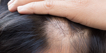 "A close-up of a person's scalp with dark hair, showing visible hair thinning or early signs of hair loss. A hand is gently pulling back the hair to reveal the affected area.