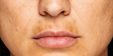 "A close-up of a woman's lower face, highlighting hyperpigmentation or melasma above her upper lip. Her skin has visible freckles and uneven skin tone.