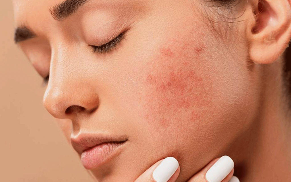 What causes adult acne and how to treat it